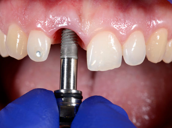 Implantes Dentários