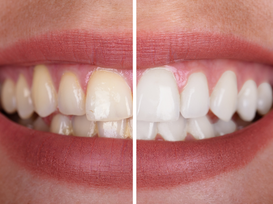 Clareamento Dental